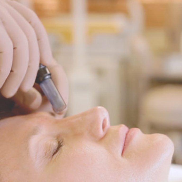 cosmopen-microneedling-inuse1